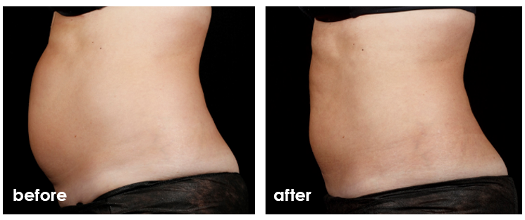 before and after sculpsure testimonials