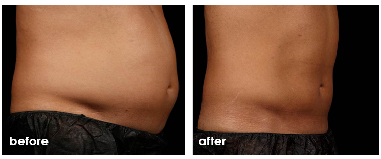 before and after sculpsure testimonials